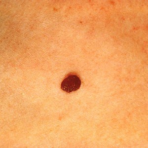 Read more about the article Moles can change in appearance
