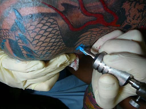 You are currently viewing What are the risks of tattoo laser removal?