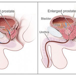 Read more about the article What types of treatment are there for enlarged prostrate?